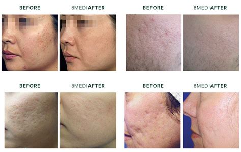 Acne Scar Removal Treatment - Safe and effective Acne Scar Treatment