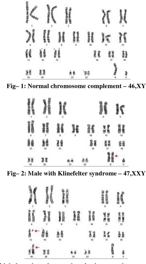 Figure 1 from Chromosomal Abnormalities of Infertile Men in a Tertiary Care Teaching Hospital ...