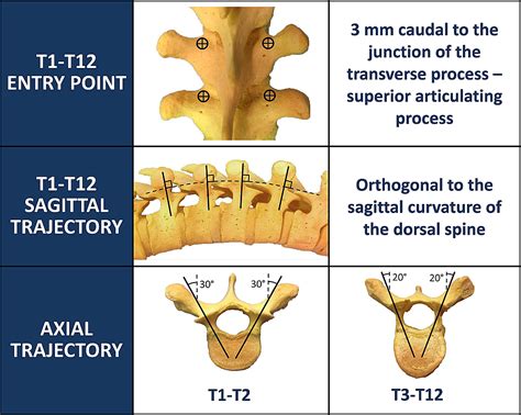 Cureus | Freehand Thoracic Pedicle Screw Placement: Review of Existing Strategies and a Step-by ...