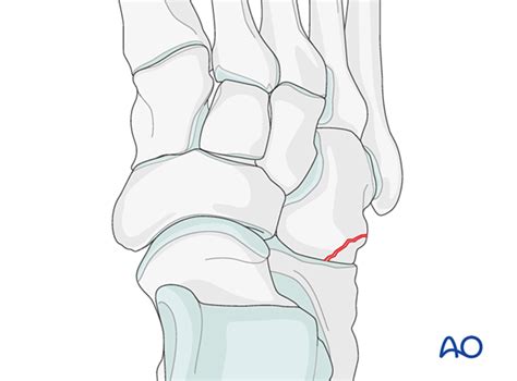 Cuboid avulsion fracture