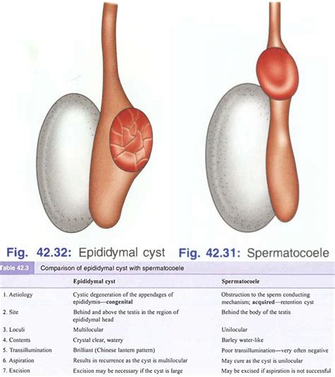 Epididymal Cyst