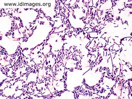 Clostridium Images - Infectious Disease Images - eMicrobes Digital Library - Atlas