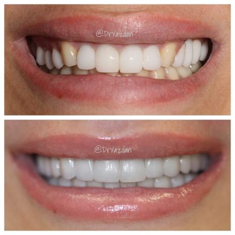 The Difference Between A Crown & Veneer - Center for Restorative ...