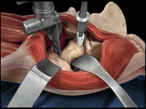 Direct Anterior Approach Hip Replacement - YouTube