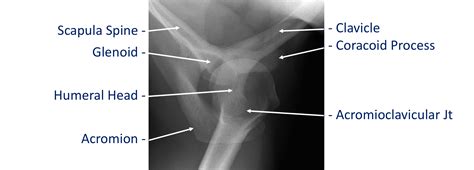 Scapula Anatomy Xray