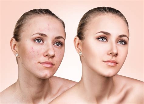 The Skin Before and after Acne Removal by the Experts