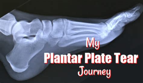 Plantar Plate Tear Injury – Joyful Miles