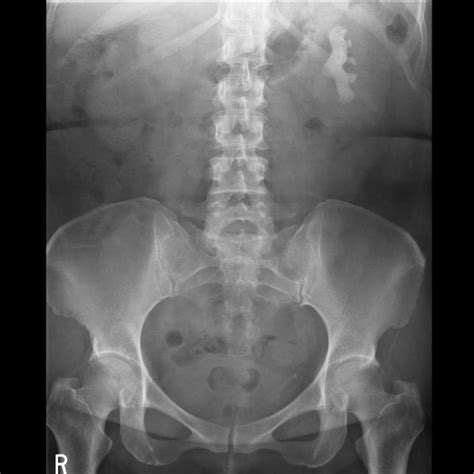 Kidney stone x ray - wikidoc