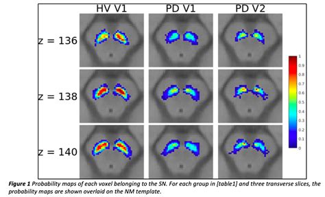 Evaluating Volume Changes in the Substantia Nigra Pars Compacta (SNc) in Parkinson’s Disease (PD ...