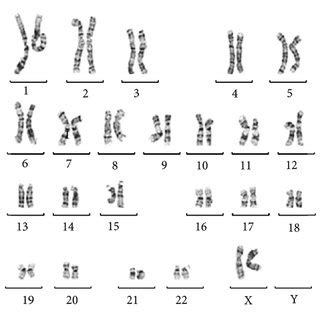 The monosomy 21 cell line is not shown. (a) G-banded fibroblast ...