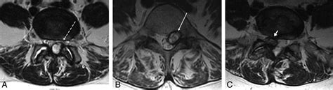 Lumbar Facet Joint Synovial Cysts: Does T2 Signal Intensity Predict Outcomes after Percutaneous ...