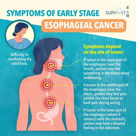 Esophageal Cancer: Symptoms More, 51% OFF