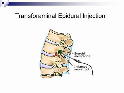 Transforaminal Injections - Amara Pain & Spine Management