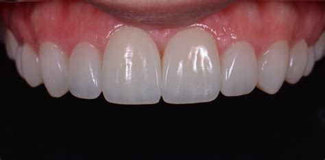 Composite Resin Veneers – Buying or Starting a Dental Practice