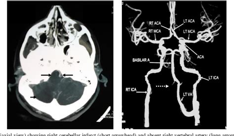 Vertebral Artery Ct Scan