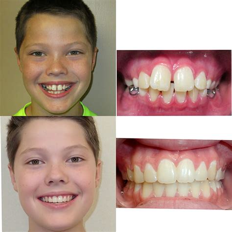 Before & After Braces | Wazio Orthodontics