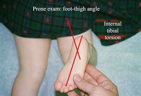 Internal tibial torsion - annotated | 3-year-old girl, norma… | Flickr