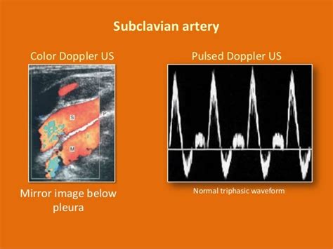 Subclavian Artery Waveform Ultrasound