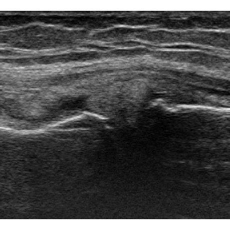 (a) Cartilage thickness of the femoral medial condyle. (b) Depiction of... | Download Scientific ...