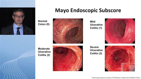 What Determines “Quality” for Endoscopy Reporting in IBD Patients? - YouTube