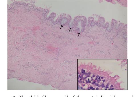 [PDF] Postoperative Maxillary Cyst: A Case Report | Semantic Scholar