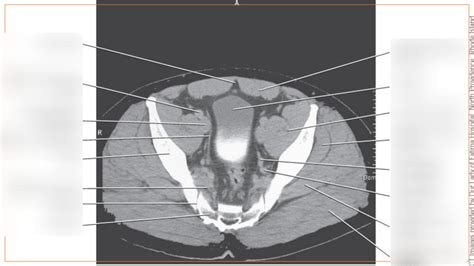 Sectional Anatomy: CT images of the Pelvis: AXIAL 15 Diagram | Quizlet