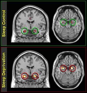 Sleep Deprivation and Its Effects on The Brain | Sleep Centers of Middle Tennessee