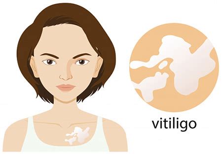 Vitiligo (Leucoderma) Treatment in Ayurveda with Herbal Remedies - Dr. Vikram's Blog - Ayurvedic ...