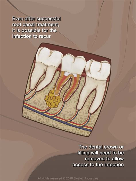 Root Canal Retreatment