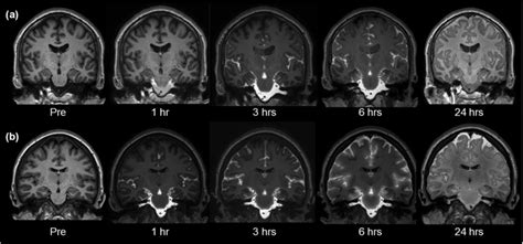 Intrathecal injection of gadobutrol in a dose of (a) 0.25 mmol (0.25 ml... | Download Scientific ...