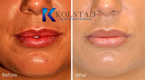 Lip Augmentation San Diego | San Diego & La Jolla Lip Fillers