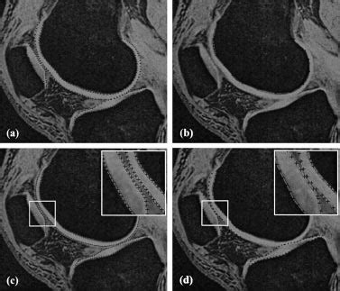 Cartilage-specific MR image of the same knee joint as in Fig. 1 ...