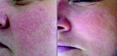 38 years old female with facial telangiectasia before and after two ...