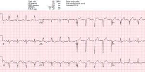 Pathological Q Wave