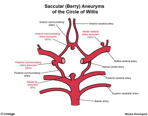 Charcot Artery Of Cerebral Hemorrhage - Stroke: Hypertensive ...