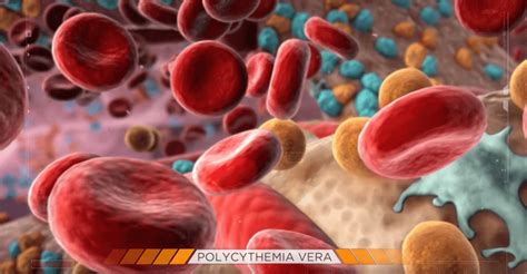 Understanding Polycythemia Vera | MPN Cancer Connection