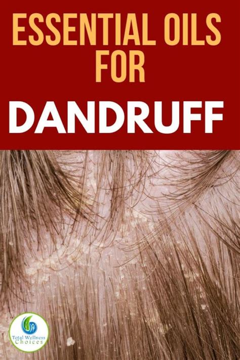 Top 9 Essential Oils for Dandruff | Oils for dandruff, Dandruff remedy, Dandruff