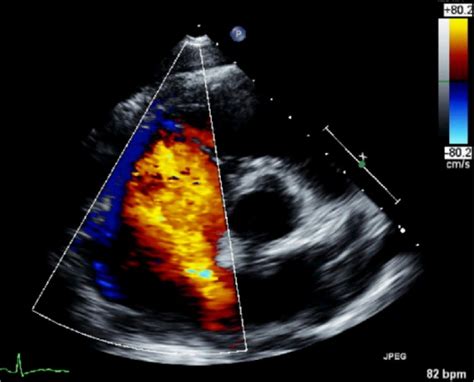 Atrial septal defects - clinical manifestations, echo assessment, and ...