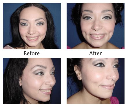 Demystifying Dimpleplasty: A Guide to the Dimple Creation Procedure - Else Jones