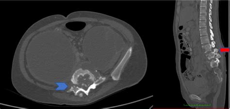 Figure 3 from Pott's disease with extensive cold abscess in the abdominal cavity which was ...