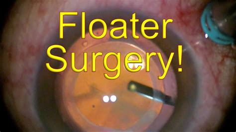 Floater Only Vitrectomy (FOV) for MASSIVE vitreous floaters - Dr Simon ...