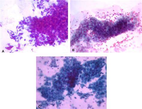 A , Atypical endocervical cells (NOS) .A sheet of endocervical cells... | Download Scientific ...