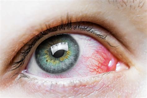 Manchas rojas en los ojos: ¿por qué se producen? — Mejor con Salud