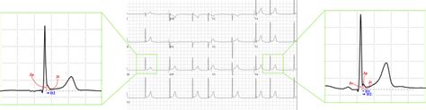 Early repolarization patterns. Example of an early repolarization ...