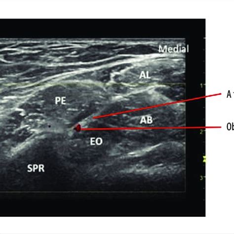 Schematic diagram of the femoral obturator nerve block (FONB). AL ...