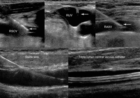 Ultrasound-guided vascular access: Trends and perspectives | Radiology Key