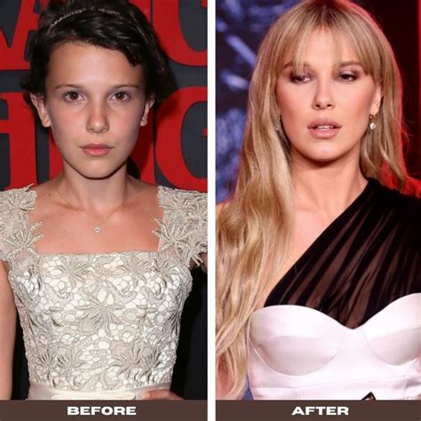 Did Millie Bobby Brown get plastic surgery?