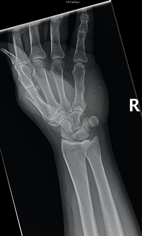 Avulsion Fracture Of Styloid Process Of Ulna