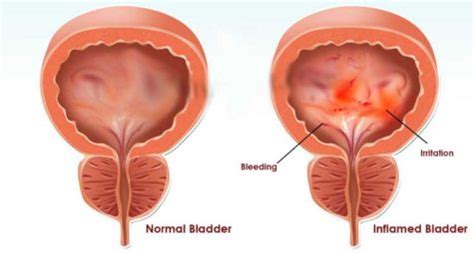 Cystitis-–-Bladder-Infection-Symptoms | Folk Medicine Remedies and Cures