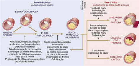 Entenda como a Aterosclerose funciona